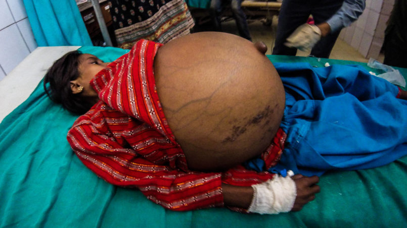 Young girl suffering from ascites