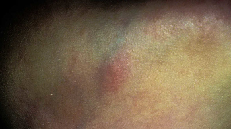 Bedbugs bites on the neck